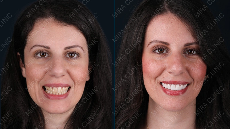The results of amal veneers experience